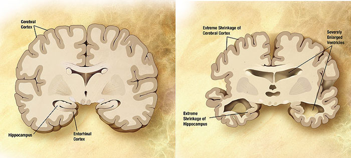 Normal and Alzheimer brain slices